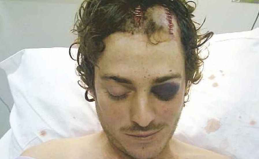 Bash victim Mathew Clayton after being attacked by Craig Cameron in July last year. Cameron was jailed for the attack yesterday. Bash victim Mathew Clayton after being attacked by Craig Cameron in July last year. Cameron was jailed for the attack yesterday.